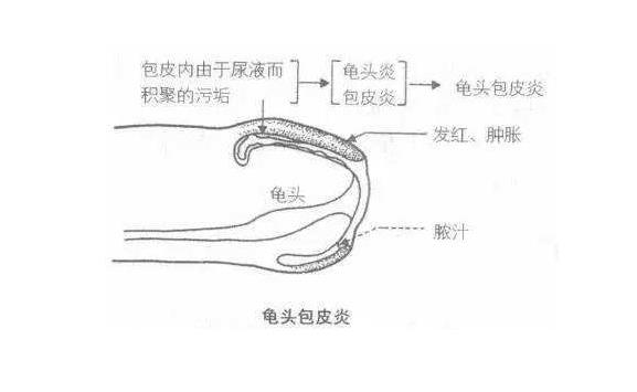 龟头口溢脓是怎么回事