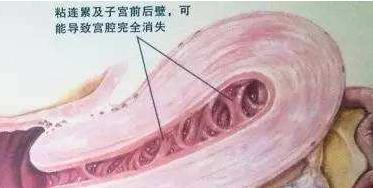 创伤性宫腔黏连是什么