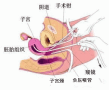 什么是清宫手术？