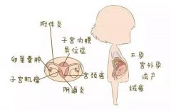 什么是子宫内膜炎？