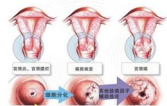 慢性宫颈炎的病因