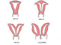 双子宫是什么情况？