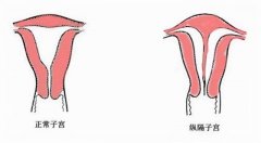 什么叫纵膈子宫？