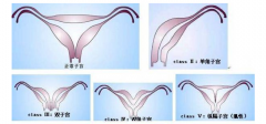 常见子宫畸形的类型