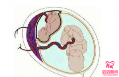 试管婴儿减胎怎么做？