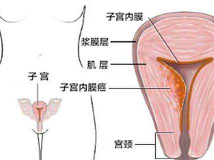 如何预防外阴囊性肿瘤