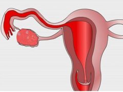 女性患有多囊卵巢能去俄罗斯做试管婴儿吗？