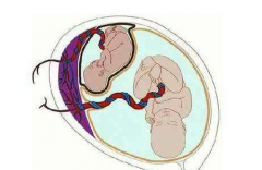 试管婴儿可以做双胞胎吗
