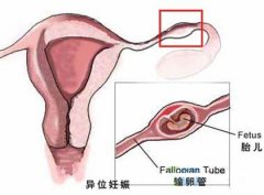 试管婴儿也会有宫外孕吗？