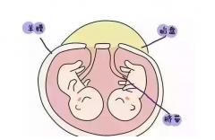 俄罗斯试管婴儿双胞胎注意事项
