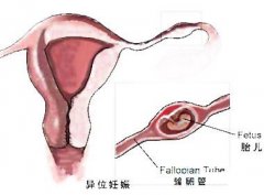 做试管婴儿会发生宫外孕么？